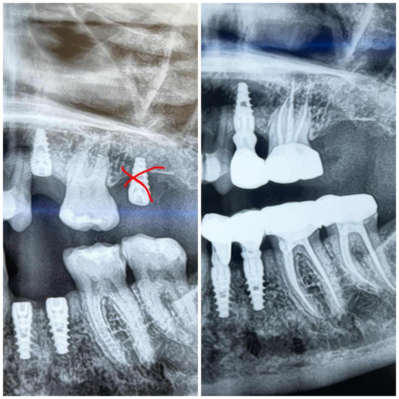 Dental Implants
