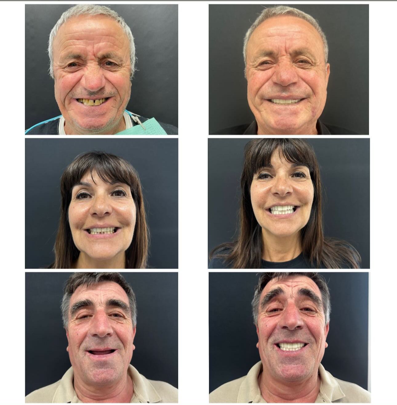 Complete Guide to Dental Implants in Albania: Costs, Process & What to Expect