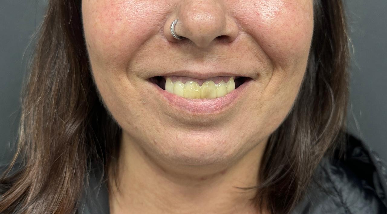 Dental Veneers: Albania vs UK — Price, Quality & Experience Compared