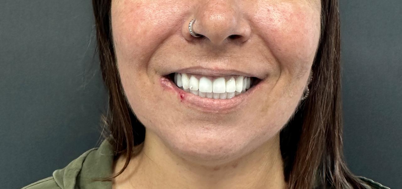 Dental Veneers