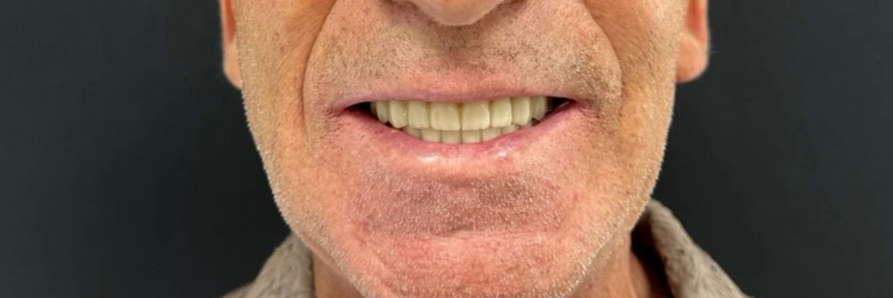 Hollywood Smile