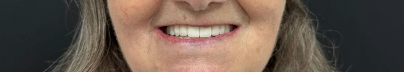 Teeth Whitening