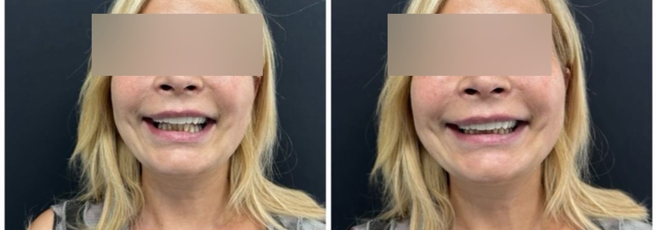 Before and after of a smile makeover — gapped, worn upper teeth restored with zirconia crowns and whitening for an even, natural-shade smile