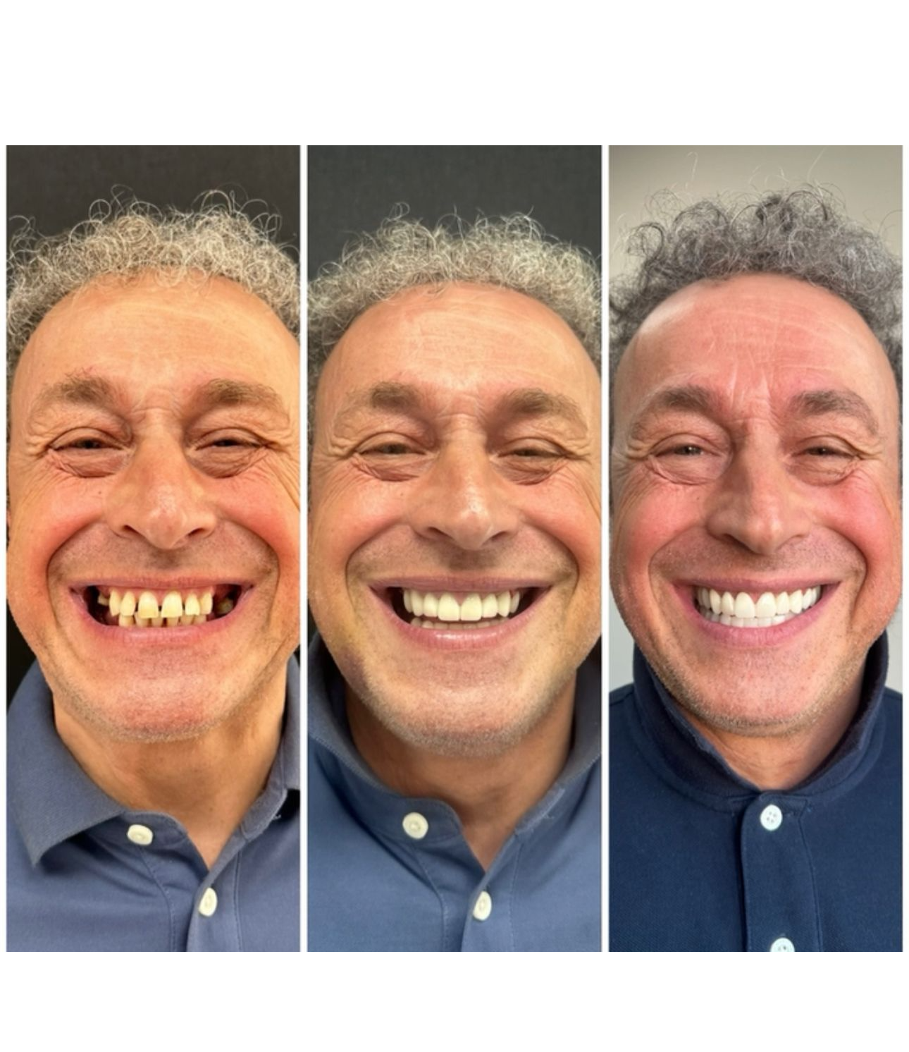 Before - All-on-X Implants
