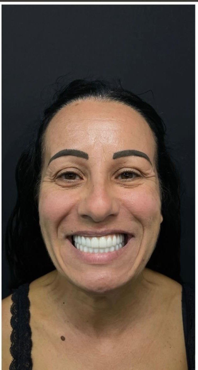 After - Full Mouth Restoration