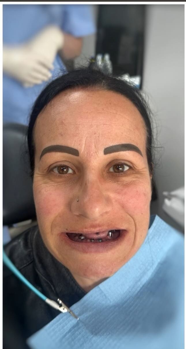 Before - Full Mouth Restoration