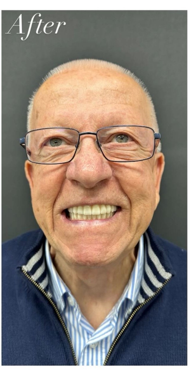 After - Full Mouth Restoration