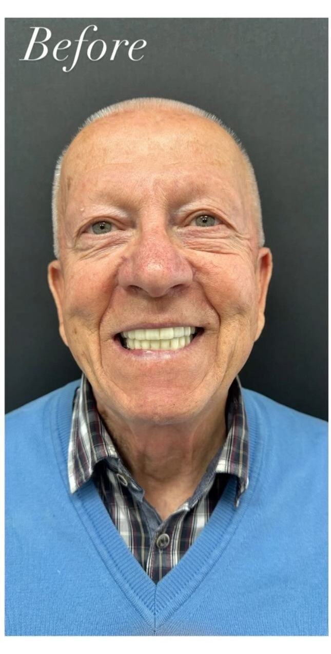 Before - Full Mouth Restoration