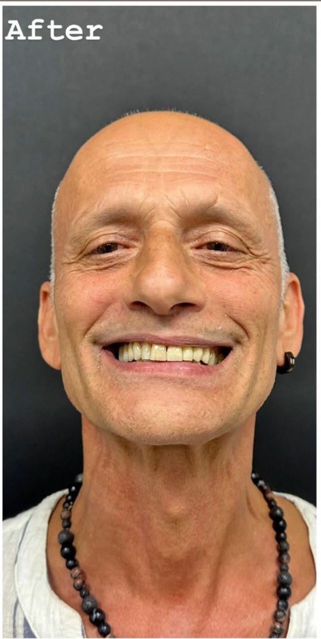 After - Dental Implants
