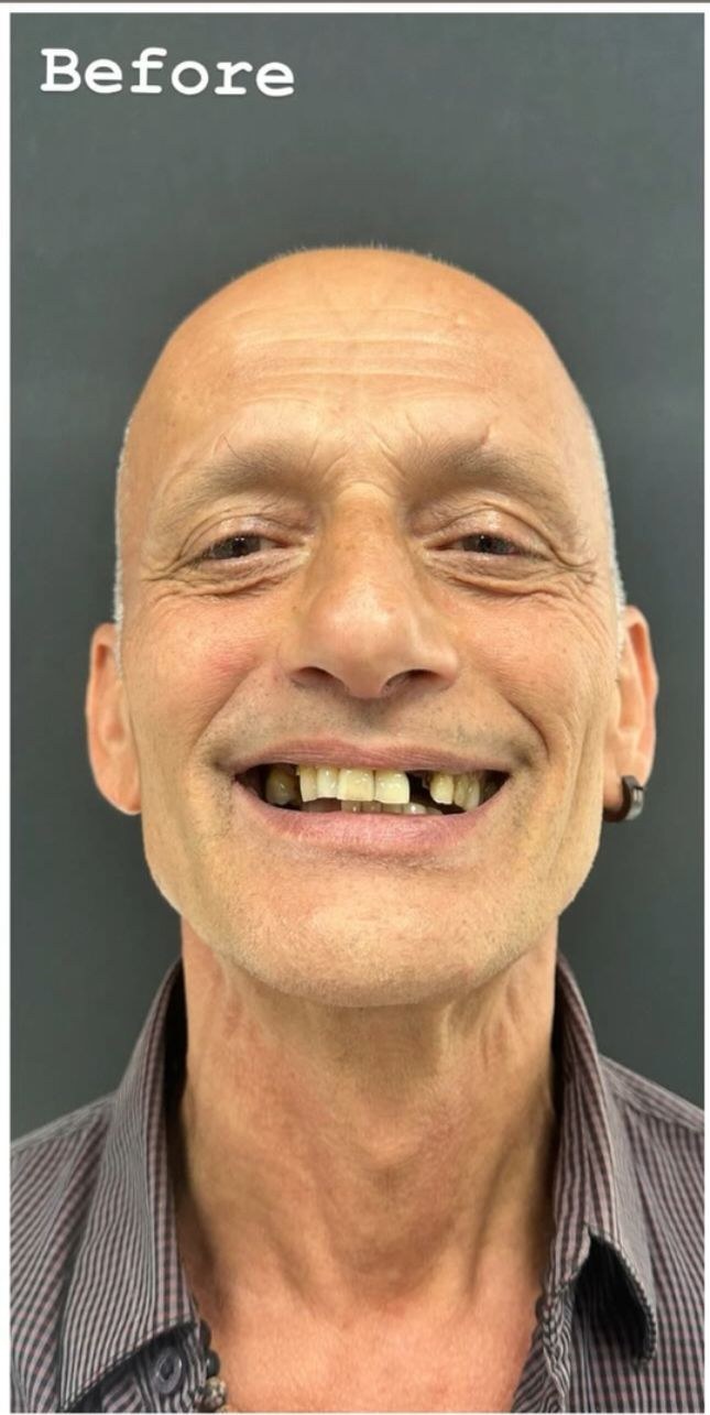 Before - Dental Implants