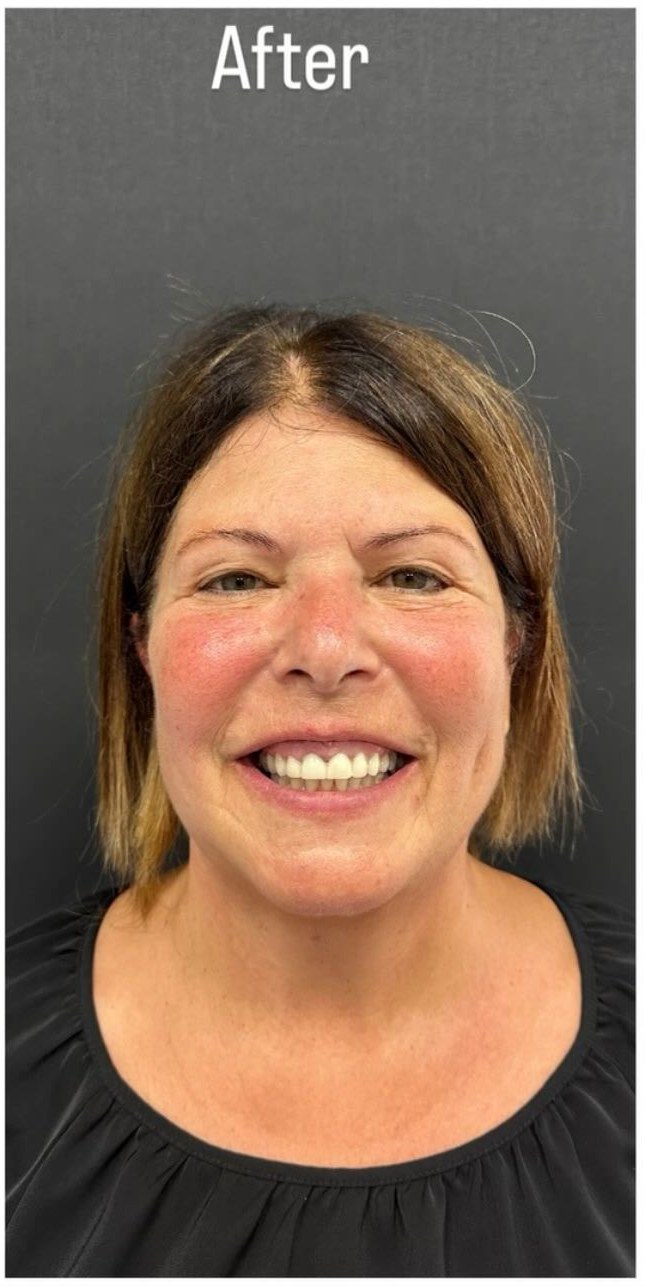 After - Smile Makeover