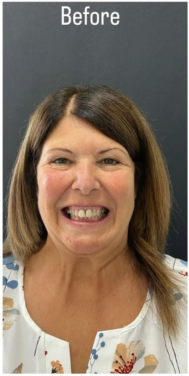 Before - Smile Makeover