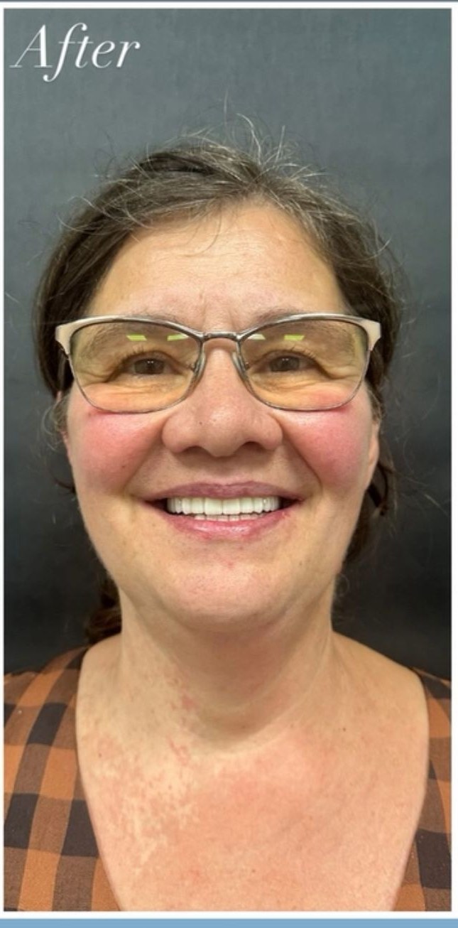 After - Smile Makeover