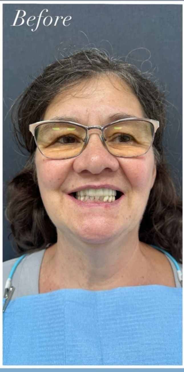 Before - Smile Makeover