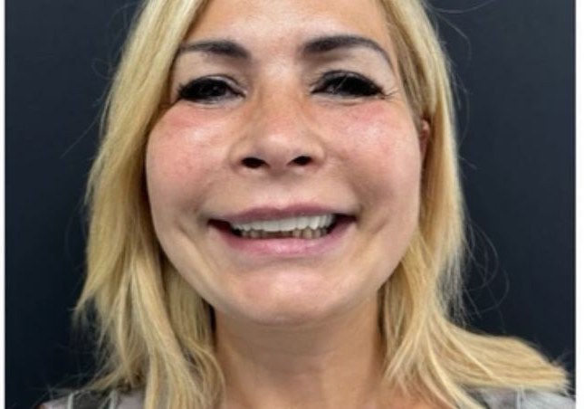 After - Porcelain Veneers