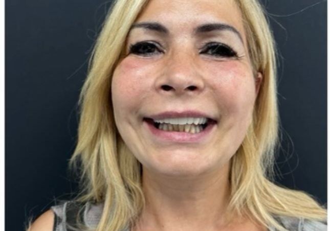 Before - Porcelain Veneers