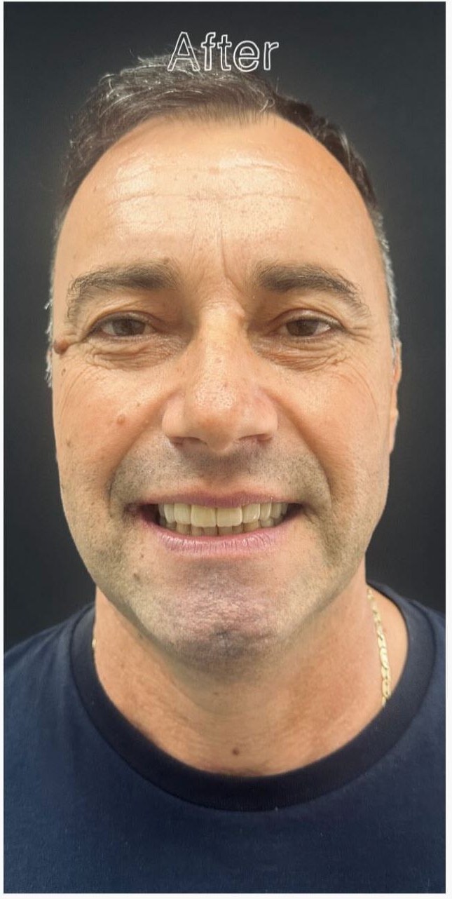 After - Porcelain Veneers