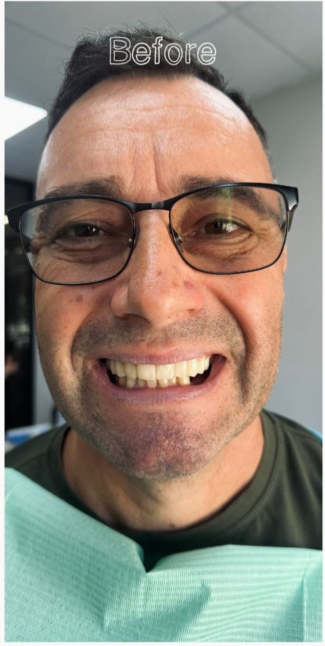Before - Porcelain Veneers