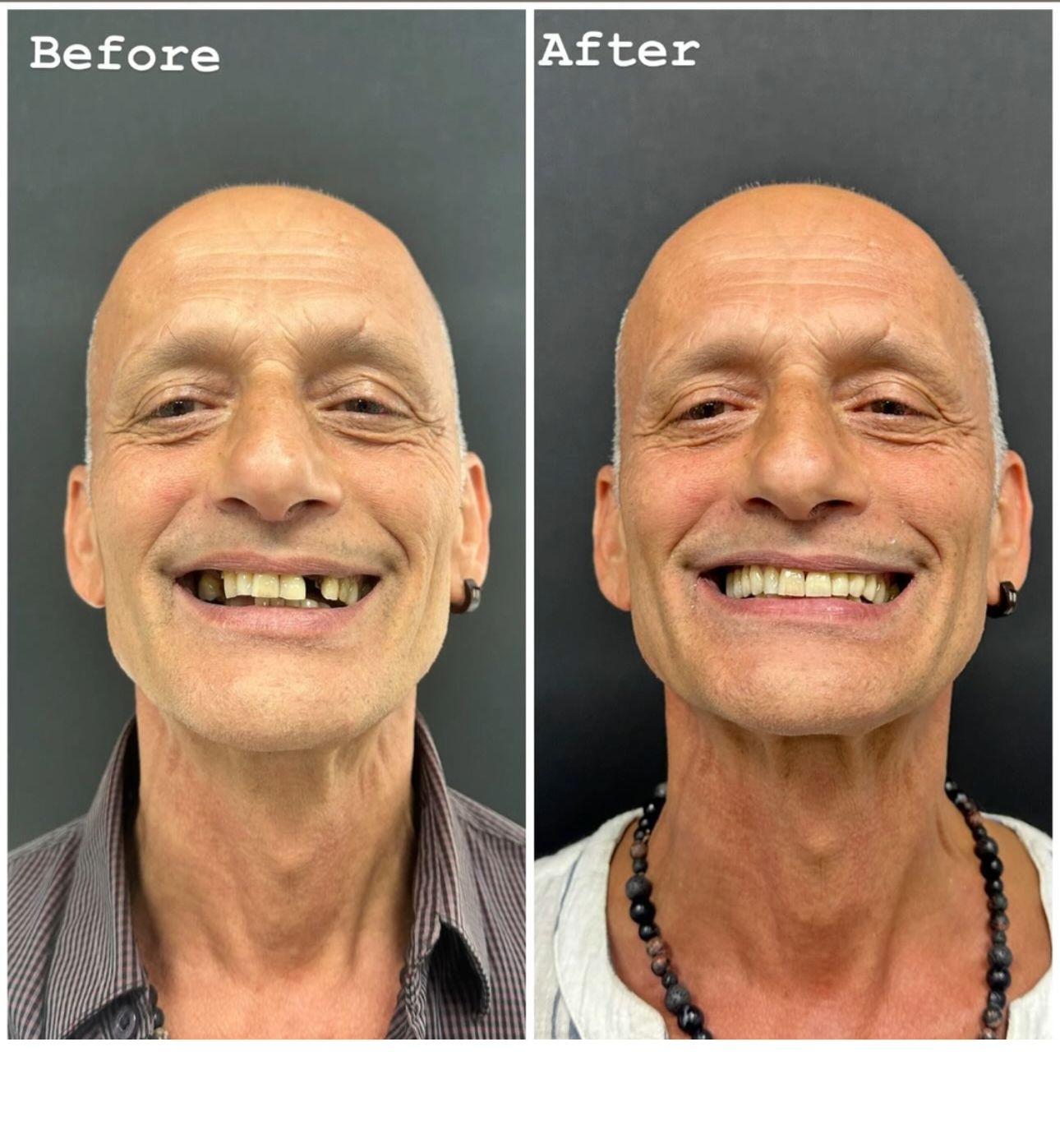 Full Mouth Restoration
