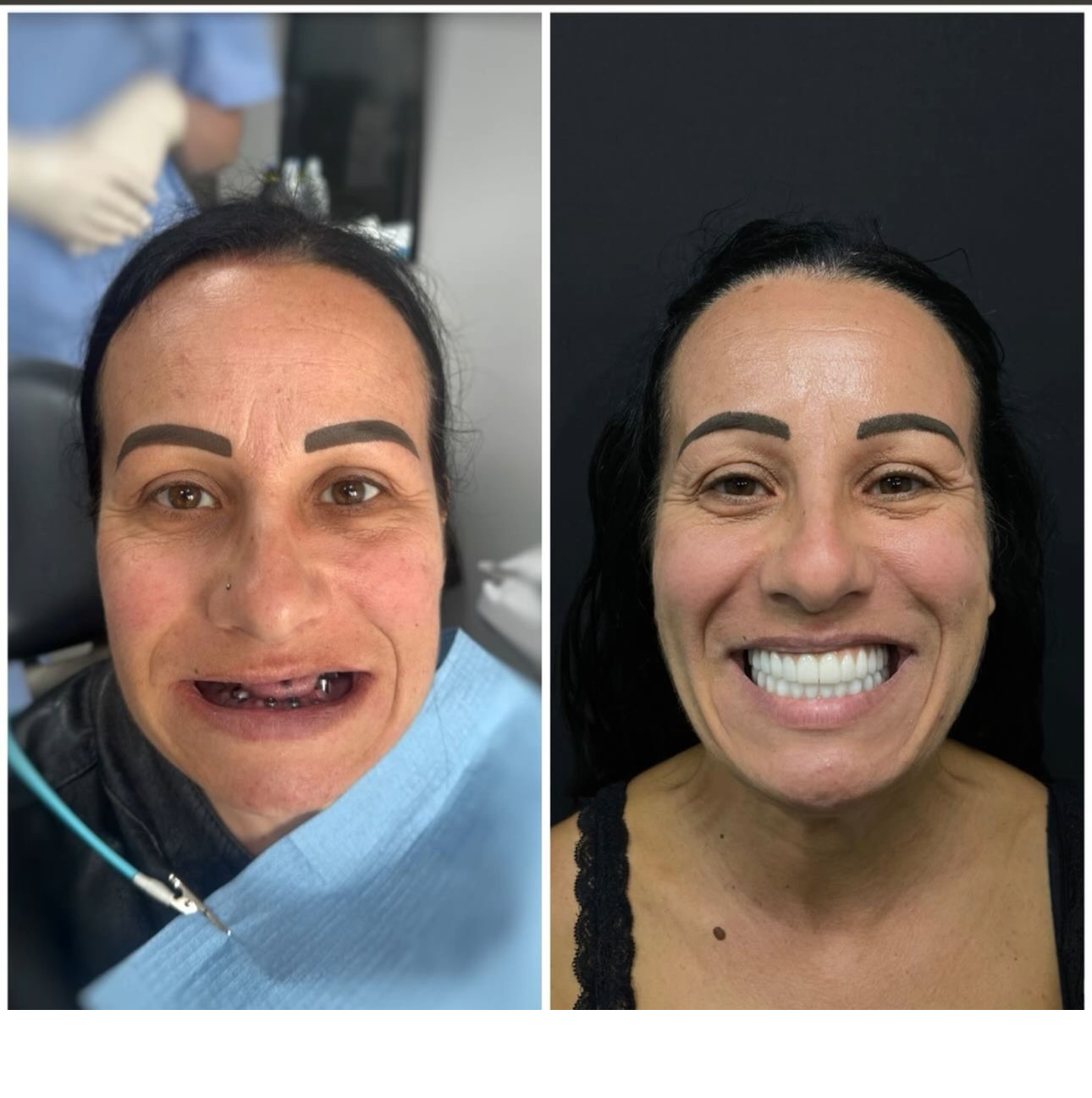 All-on-4 Implants